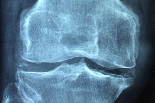 特立帕肽注射液国产首家获批！来自信立泰，礼来原研抗骨质疏松药物