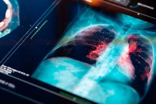 全球患病率超25%！挖掘中国新靶点，抢滩百亿NASH蓝海市场！