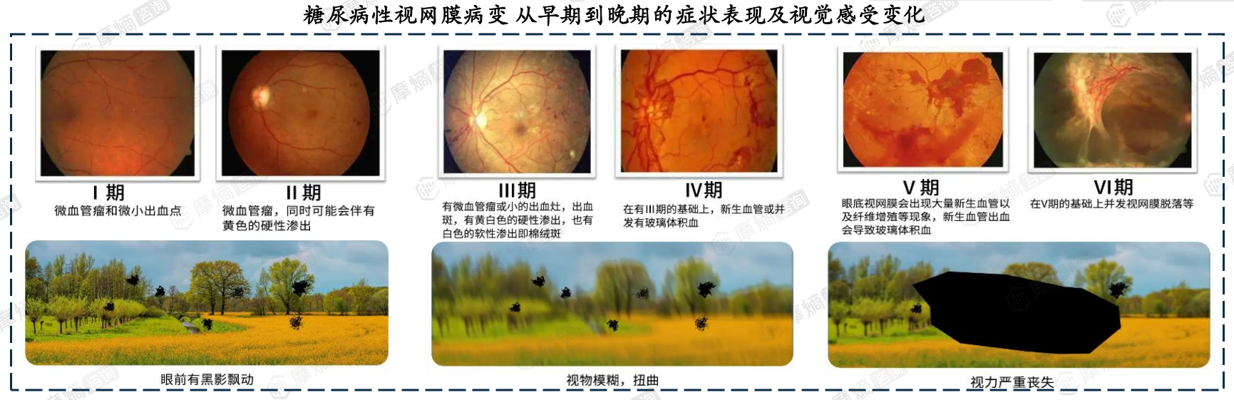 糖尿病性视网膜病变从早期到晚期的症状表现及视觉感受变化