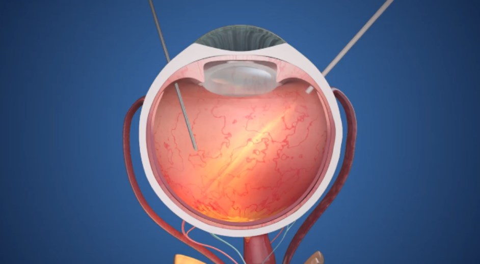 医疗器械设备之仿生视觉，面临抛售危机！