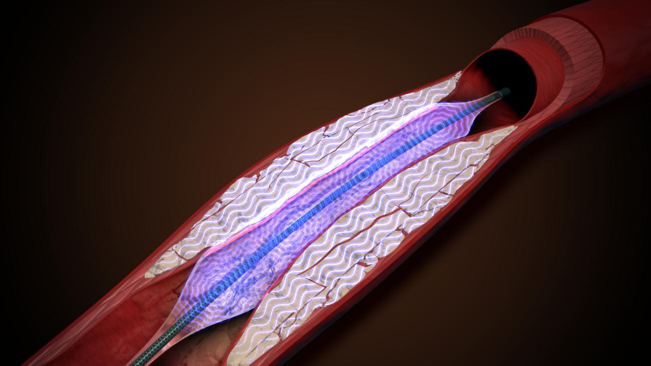 一种治疗严重钙化动脉疾病的新方法（治疗血管内钙）