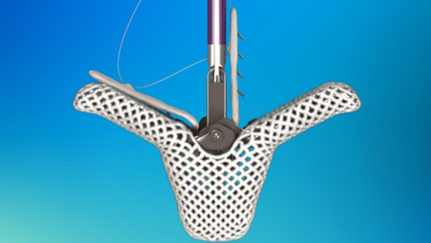 镍钛合金夹可防止 Abbott 心脏瓣膜夹滑倒