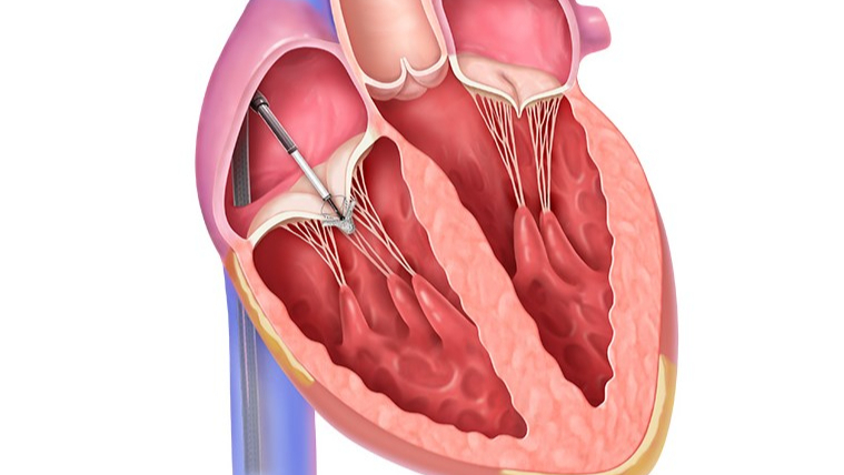 雅培如何设计 TriClip 来修复“被遗忘”的三尖瓣心脏瓣膜