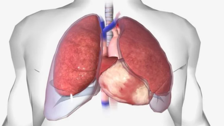 Pleural Dynamics治疗首例使用胸腔积液装置的患者