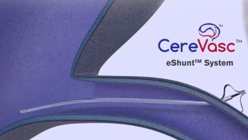 专为治疗正常压力脑积水系统获得 FDA 突破性认可