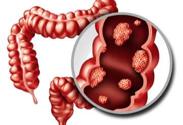 2017年美国临床肿瘤学会胃肠肿瘤研讨会(ASCO-GI)